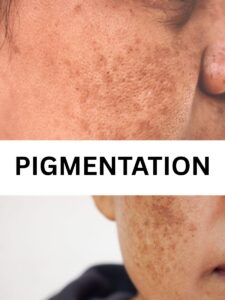 PIGMENTATION